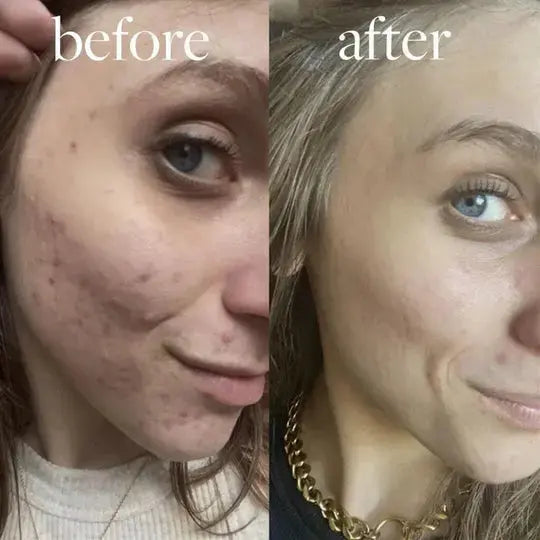 GlowLift Gesichtsstraffer