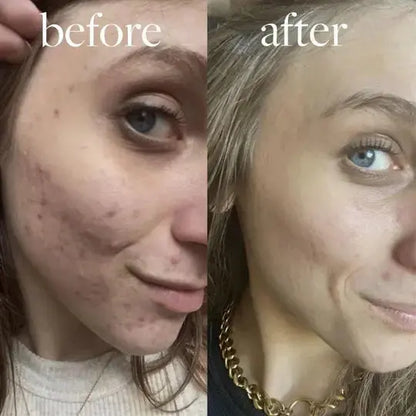 GlowLift Gesichtsstraffer