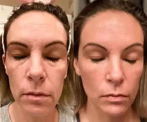 GlowLift Gesichtsstraffer