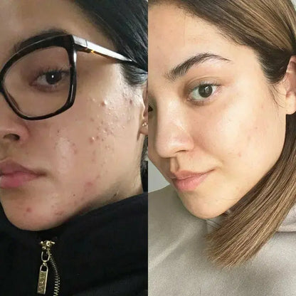 GlowLift Gesichtsstraffer